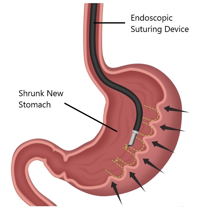 Endoscopic suturing device inside a shrunk new stomach